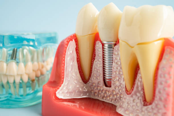 Best Dental Implants  in Tilden, NE